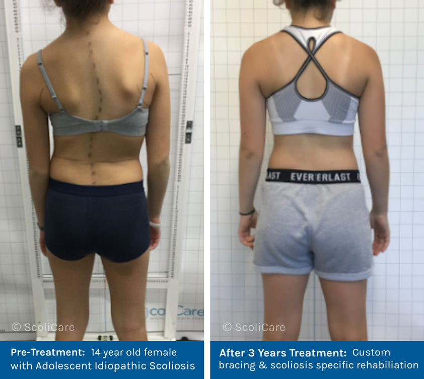 Adolescent Idiopathic Scoliosis