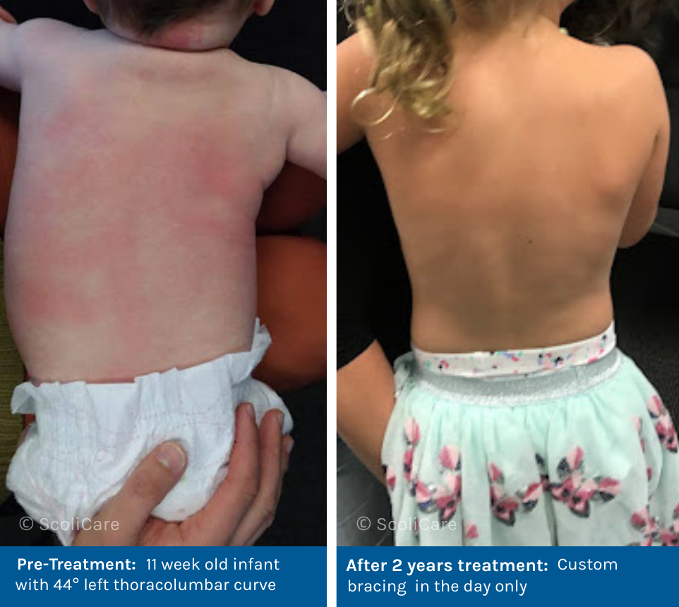 Infantile Scoliosis